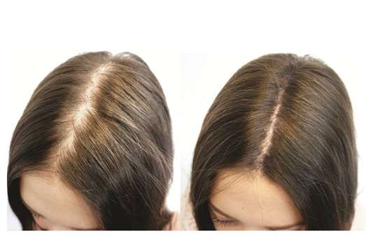 Biotin and Hair Loss